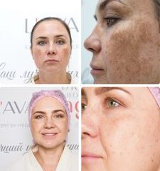 До и после — результаты